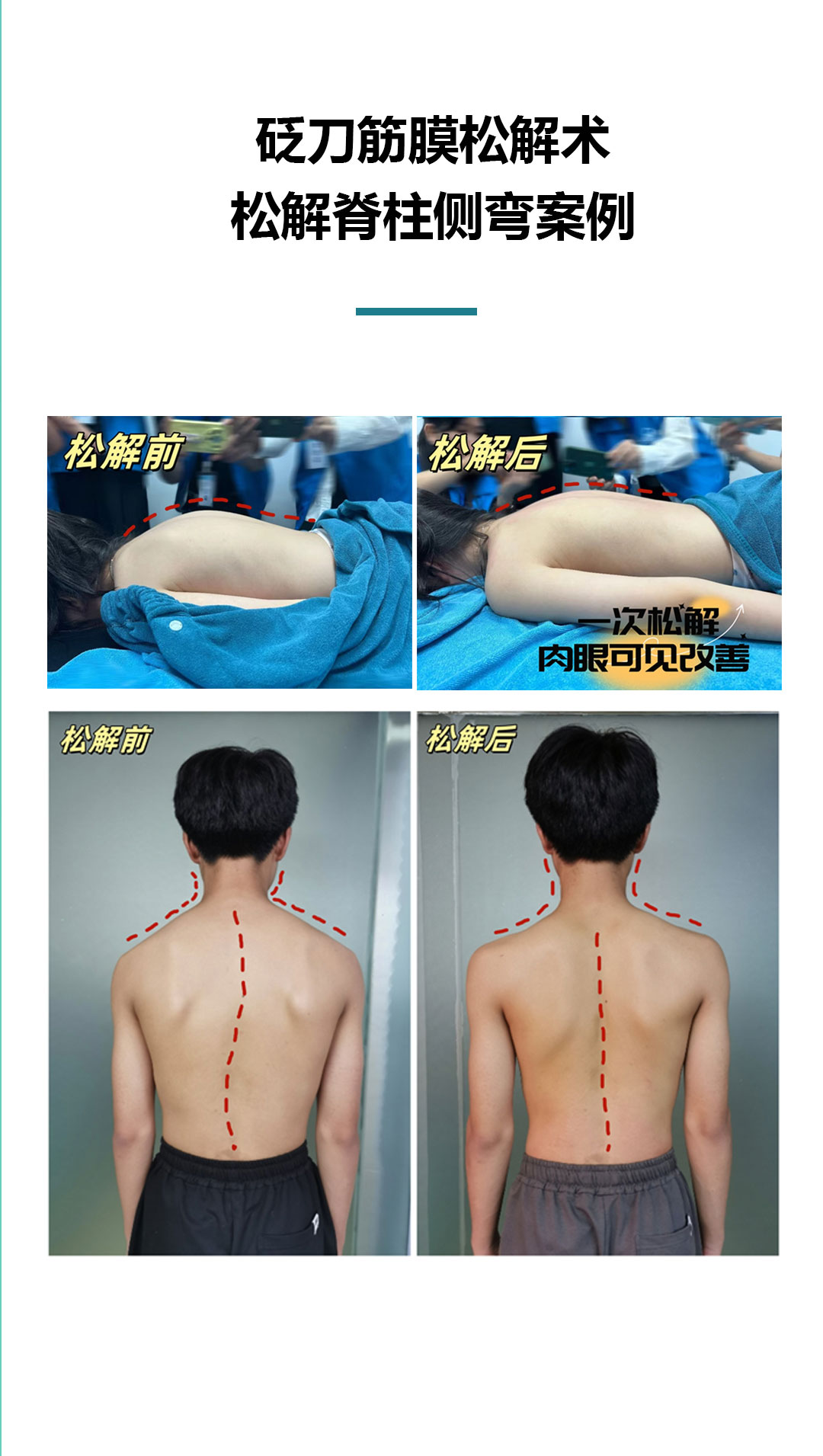 第十三篇推文（脊柱侧弯）_08.jpg