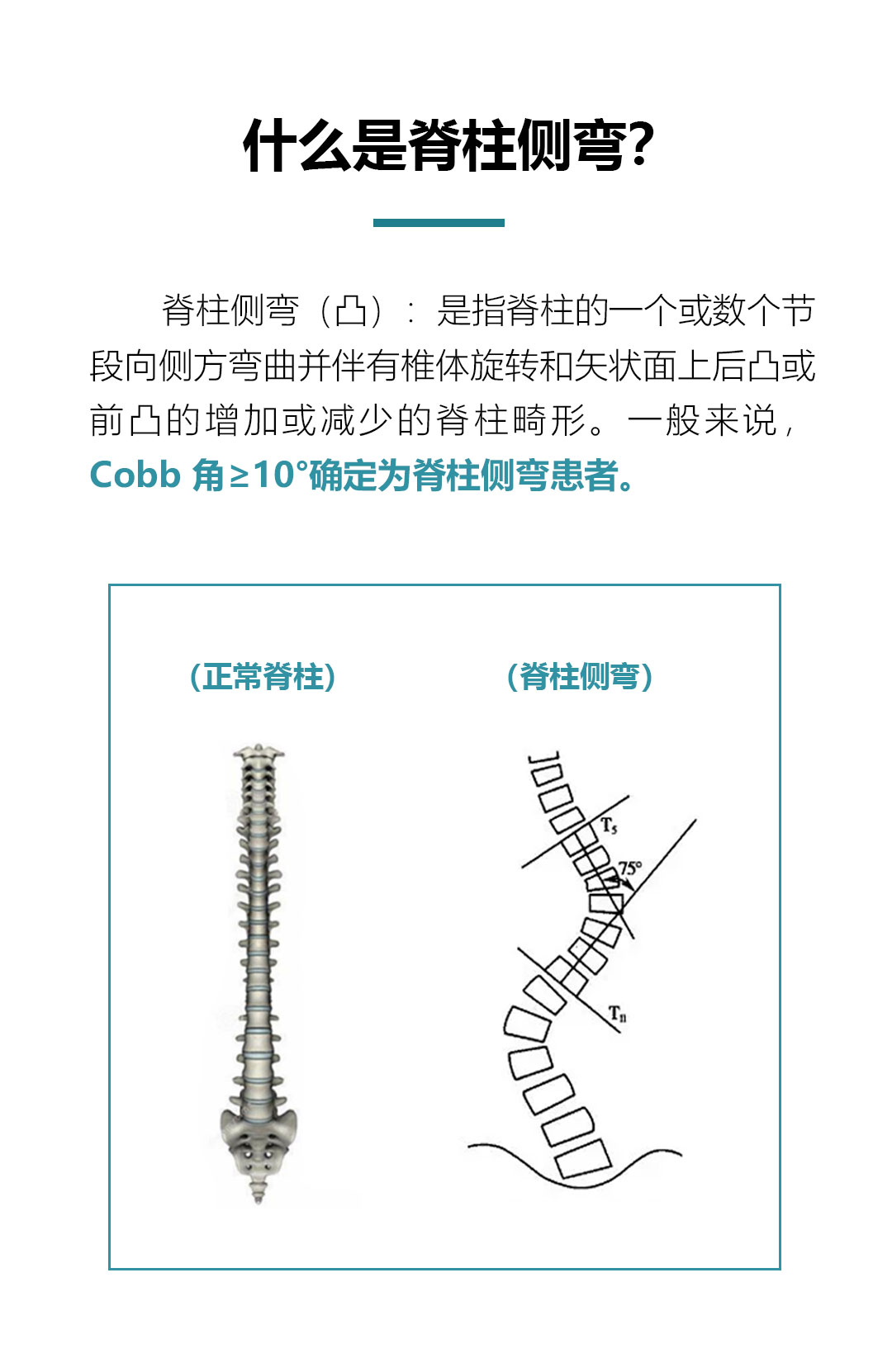 第十三篇推文（脊柱侧弯）_02.jpg