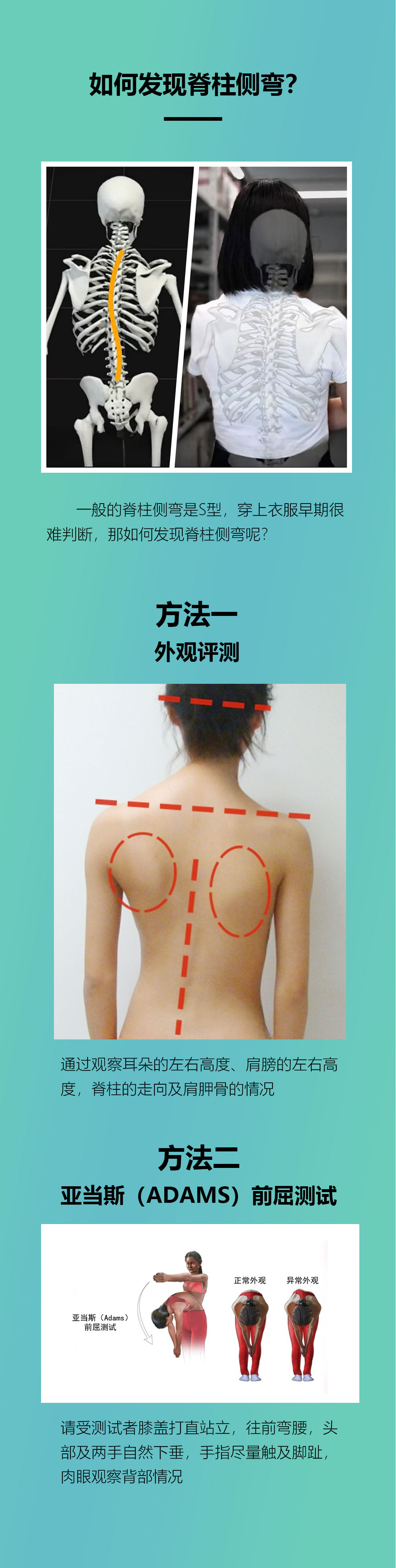 第十三篇推文（脊柱侧弯）_05.jpg