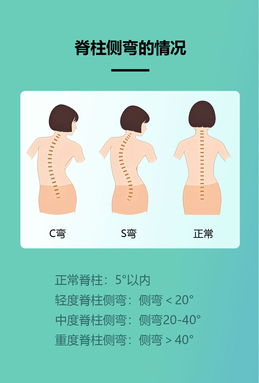 第十三篇推文（脊柱侧弯）_03.jpg